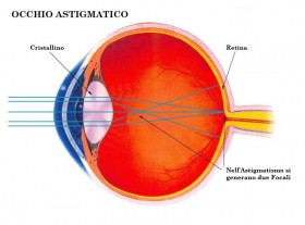 Occhio astigmatico - OUTLOOK - Outlet dell'Occhiale